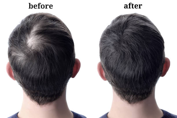 GFC Hair Treatment